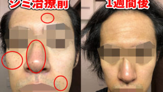 ゴリラクリニックのシミ治療正面チェックポイント付