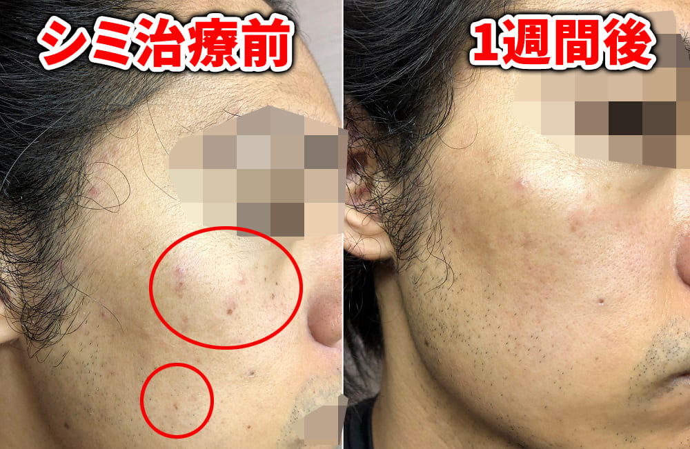 ゴリラクリニックのシミ治療右側チェックポイント付