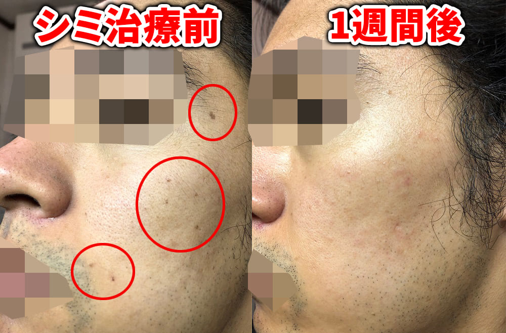 ゴリラクリニックのシミ治療左側チェックポイント付