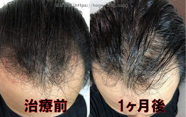 AGA治療前と治療開始1ヶ月後の頭頂部の比較
