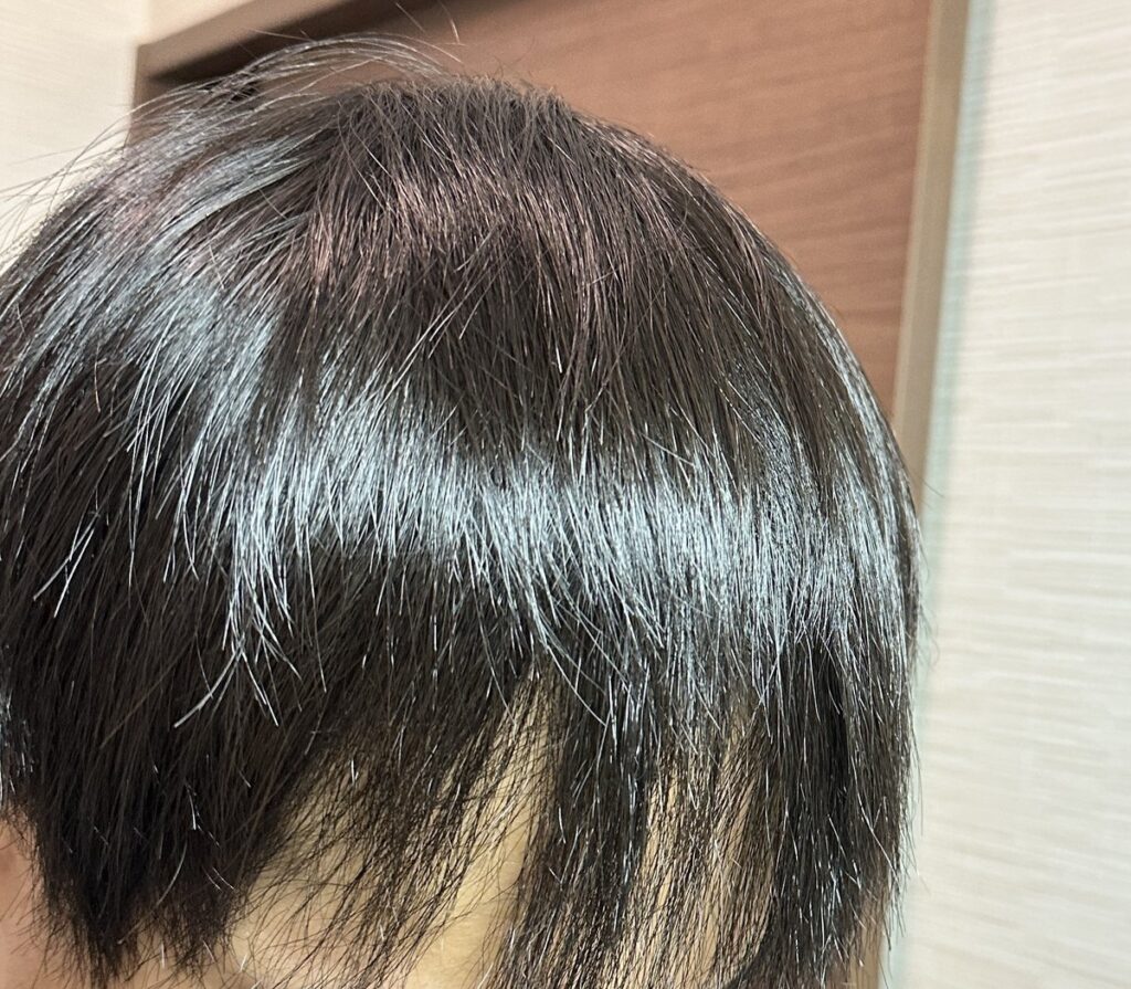 植毛手術前の頭部（乾いた状態・右1）