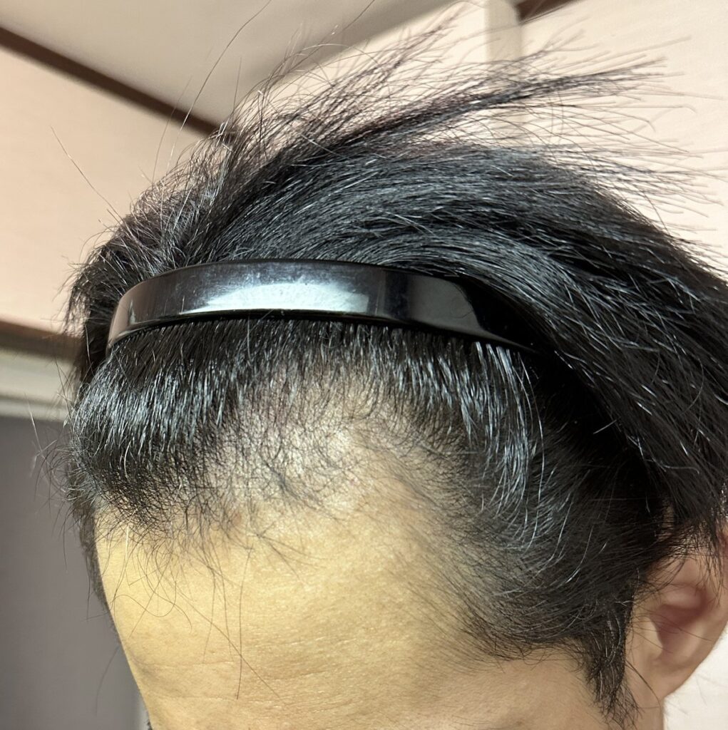 植毛手術前の頭部（乾いた状態・左2）
