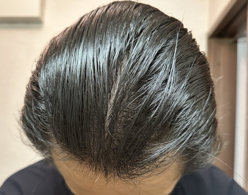 植毛手術前の頭部（濡れた状態・正面）