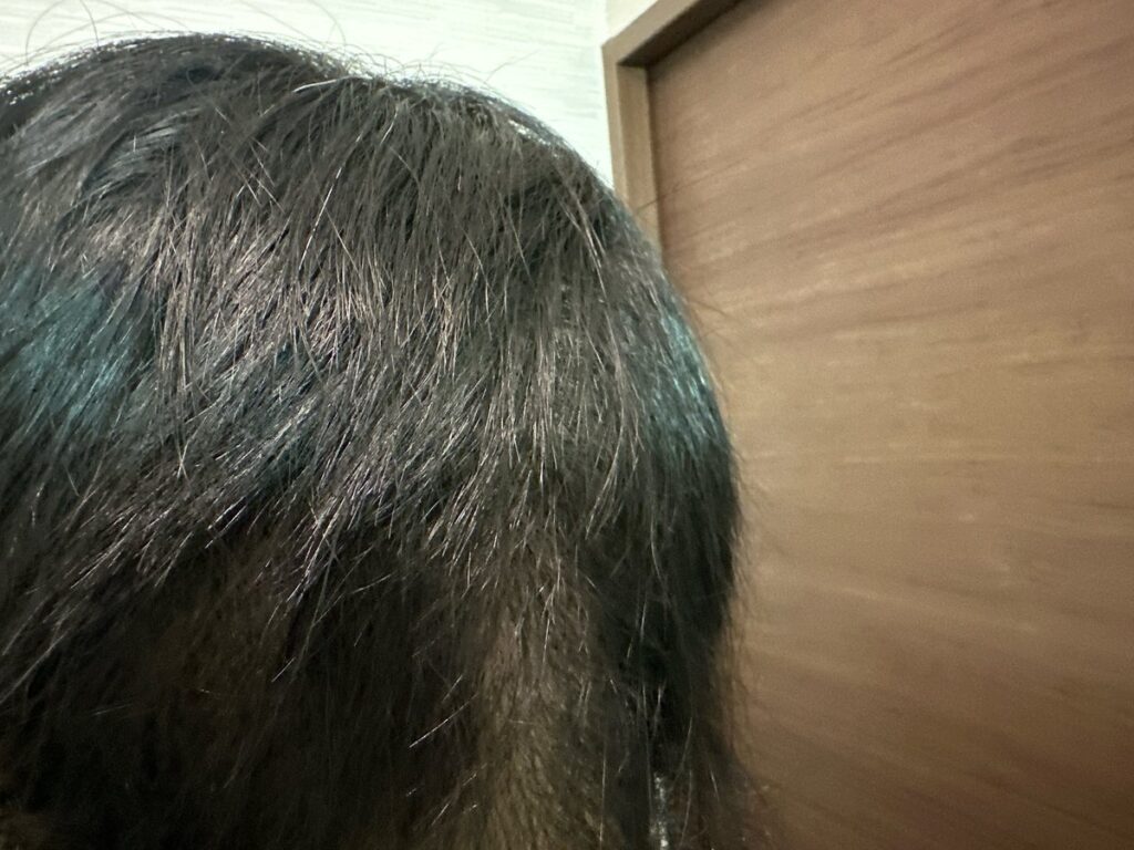 植毛手術から1週間後の頭部（後ろ1）