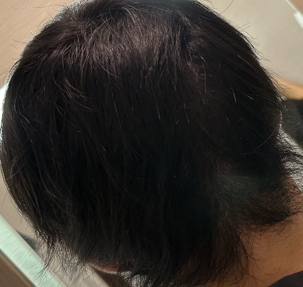 植毛手術から1週間後の頭部（後ろ2）
