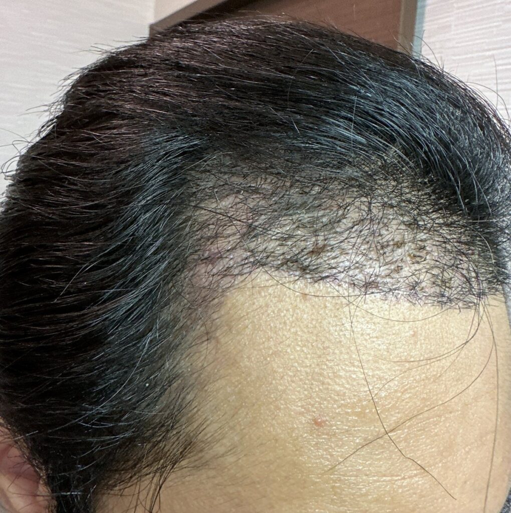 植毛手術から3週間後の頭部（右）