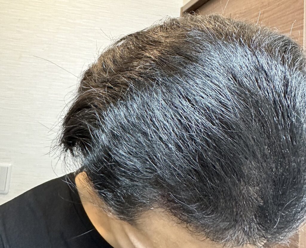 植毛手術から4ヶ月後の頭部（右2）