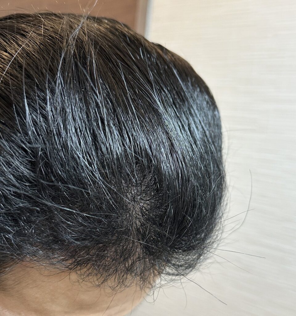 植毛手術から5ヶ月後の頭部（右4）