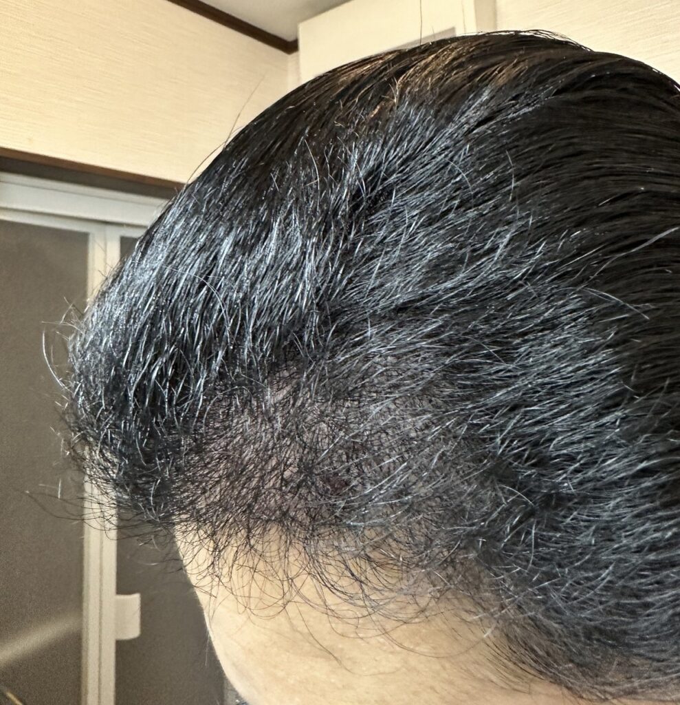 植毛手術から6ヶ月（半年）後の頭部（左2）