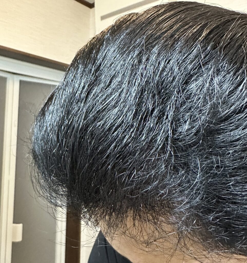 植毛手術から7ヶ月後の頭部（左4）