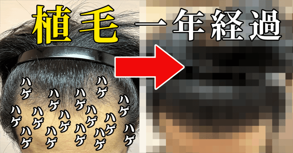 植毛から一年経過（アイキャッチ画像）