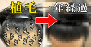 植毛から一年経過（アイキャッチ画像）
